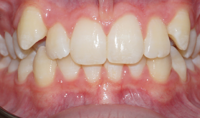 Before Fixed Orthodontic treatment at Harrow Dental