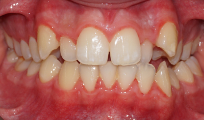 Before Fixed Orthodontic treatment at Harrow Dental