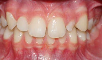 Before Fixed Orthodontic treatment at Harrow Dental