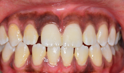 Before Fixed Orthodontic treatment at Harrow Dental