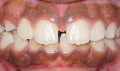 Before Fixed Orthodontic treatment at Harrow Dental