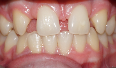Before Fixed Orthodontic treatment at Harrow Dental