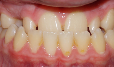Before Fixed Orthodontic treatment at Harrow Dental