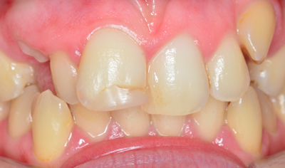 Before Fixed Orthodontic treatment at Harrow Dental