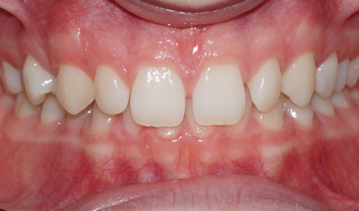 Before Fixed Orthodontic treatment at Harrow Dental