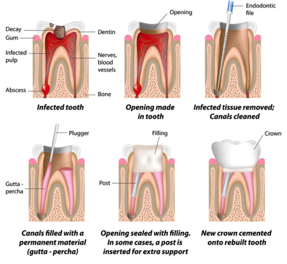 Root canal near me