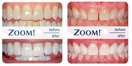 Zoom teeth whitening Essex Hornchurch