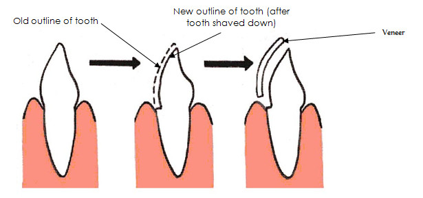 dental veneers